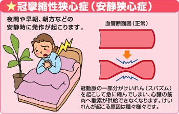 冠攣縮性狭心症
