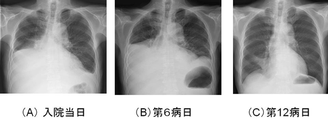 溜まる 水 肺 に 症状 が