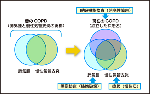 慢性 肺気腫