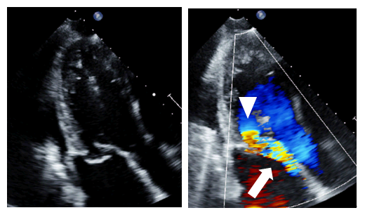 一次性と機能性僧帽弁逆流：病態の違いとは 「心臓」特別号「僧帽弁狭窄と逆流」 公益財団法人 日本心臓財団
