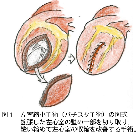 20回バチスタ手術  図1.png