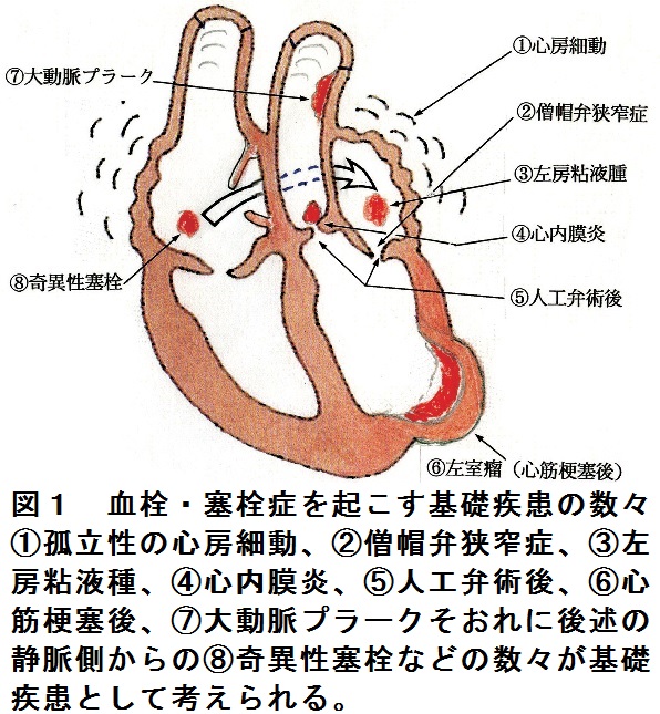 天然の血栓溶解酵素で血栓が溶けた! : 脳梗塞・心筋梗塞・血流障害からの生還者… 脳梗塞における血栓溶解療法について | 再生医療|脳梗塞・脊髄