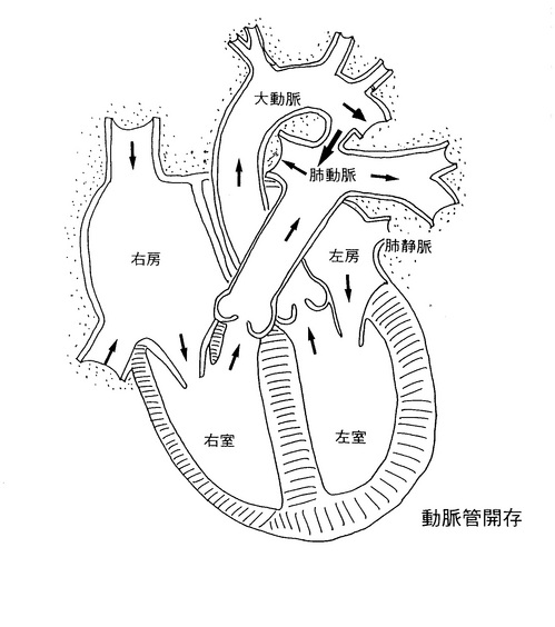 127動脈管開存.jpgのサムネイル画像