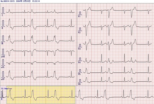 133二段脈（心室期外収縮）.JPG