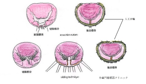 166弁形成術.jpg