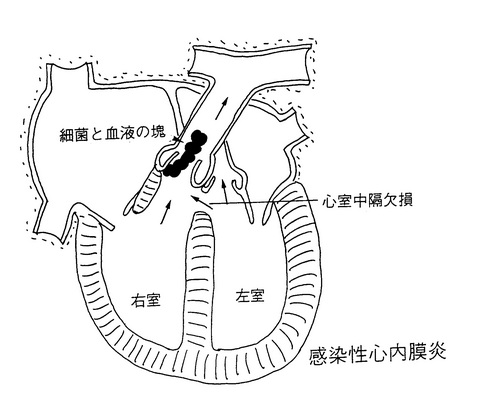 24感染性心内膜炎.jpgのサムネイル画像