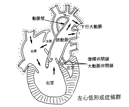 54左心低形成症候群.jpg