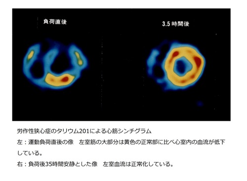 76心筋負荷シンチグラム.jpg