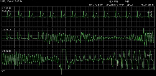79心室細動.jpg