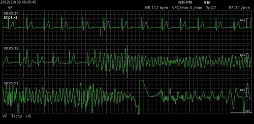 79心室細動02.jpg