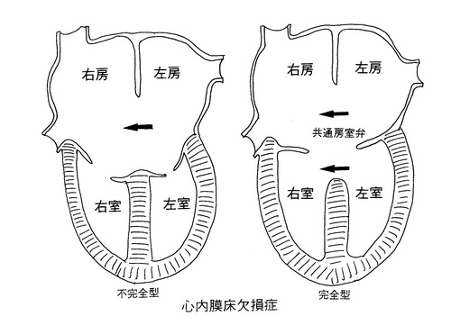 92心内膜床欠損症.jpgのサムネイル画像