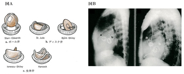 ７８人工弁図Ａは３０と同じ.jpg