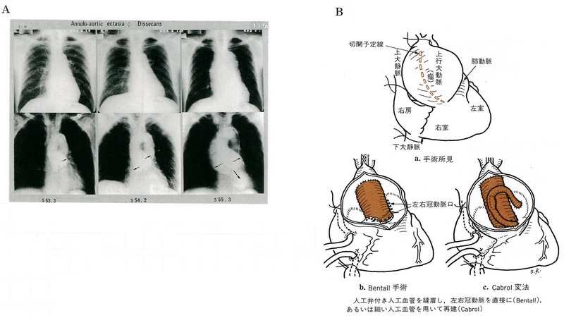 110大動脈弁輪拡張症6５共有.jpgのサムネイル画像