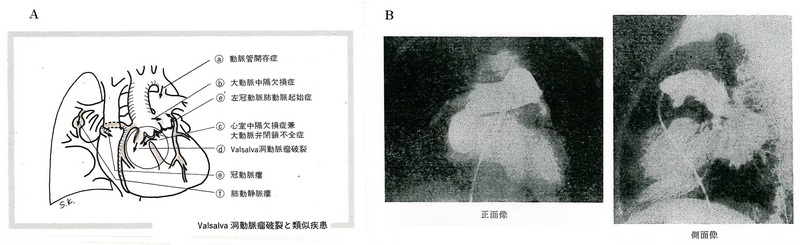 138肺動静脈瘻赤（図Ｂ-31）.jpg