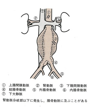 156腹部大動脈瘤.jpg