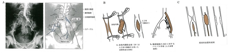 162閉塞性動脈硬化症Ａ緑ＢＣ赤.jpg