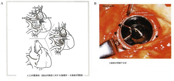 167弁置換術Ａ赤(図Ｅ-8).jpg