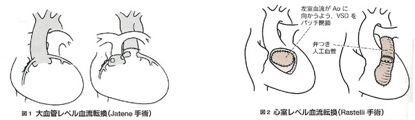 25完全大血管転位24感染性心内膜炎.jpg