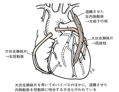 27冠動脈バイパス術赤.jpg