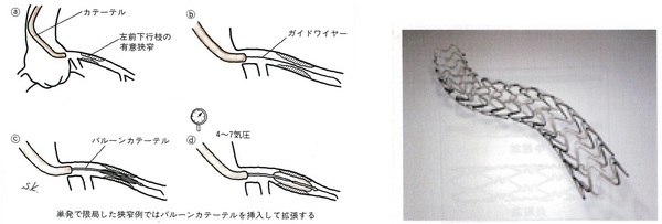 40冠動脈形成術A赤26と同じ.jpg