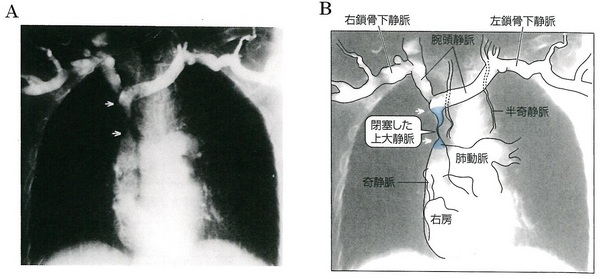 69上大静脈症候群Ｂ緑225Ｐ.jpg