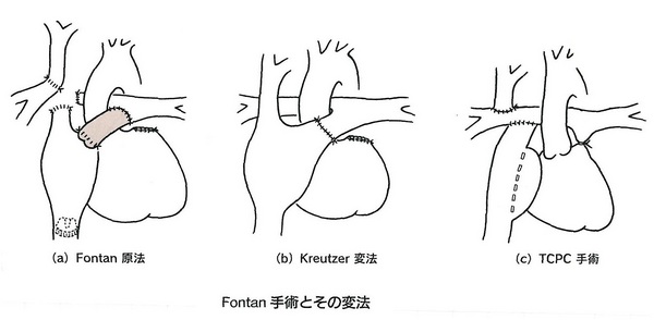 73心外導管型手術黄(図6-32）.jpgのサムネイル画像