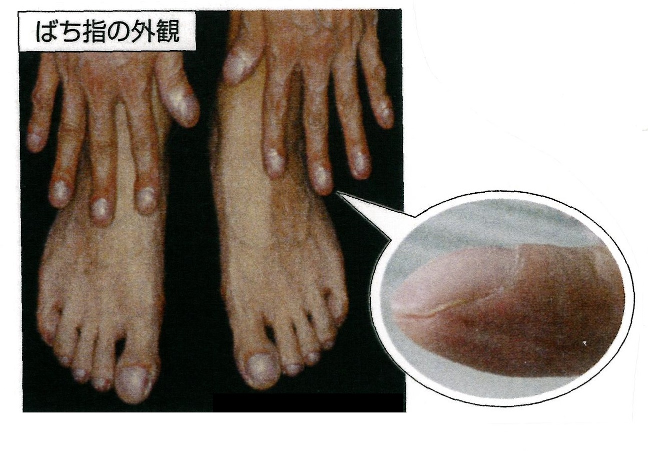 バチ状指 | 心臓病用語集 | 心臓病の知識 | 公益財団法人 日本