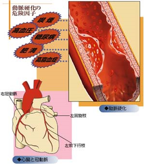 は と 血性 心 虚 疾患