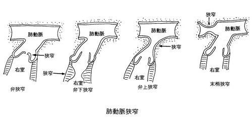 139肺動脈狭窄症 正.jpg