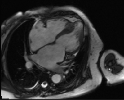 150心室中部閉塞性肥大型心筋症(MVO-HCM)のMRI.jpg