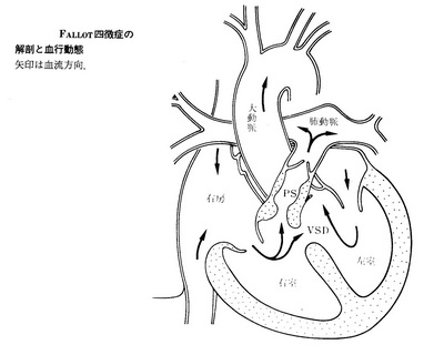 152ファロー四徴症正.jpg