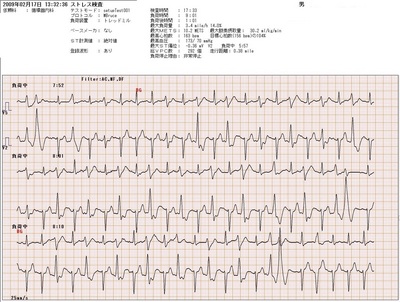 22カテコラミン02TMT負荷中.jpg