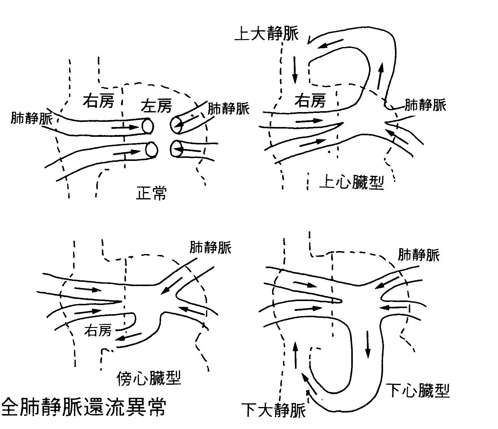 部分肺静脈還流異常 心臓病用語集 心臓病の知識 公益財団法人 日本心臓財団
