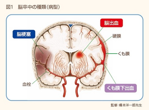 脳卒中図１.jpg