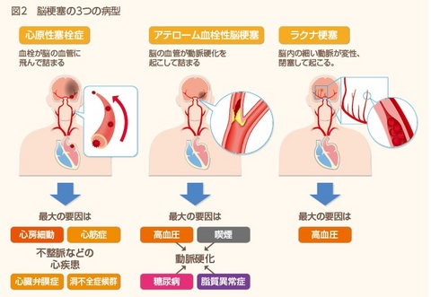 脳卒中図２.jpg