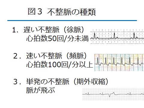 不整脈図３.jpg