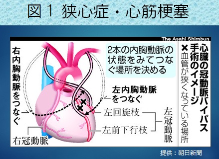 【裁断済み】循環器の重要疾患の治療法と臓器・疾患別最新の治療ガイドライン 心臓病の外科治療｜手術等｜循環器病のトピックス｜公益財団法人