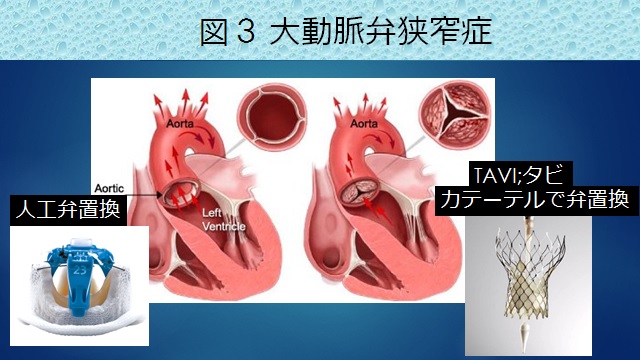 今日の心臓手術の適応と至適時期 今日の心臓手術の適応と至適時期