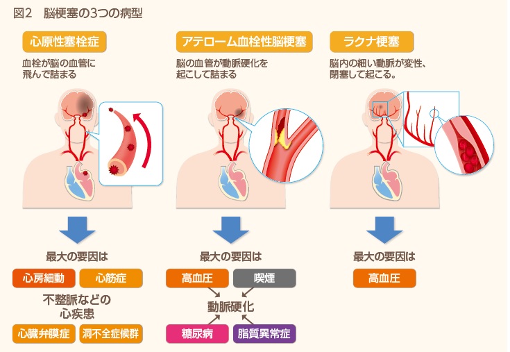 卒中 と は