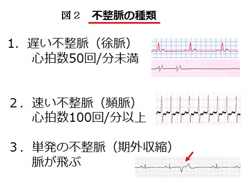不整脈 子供
