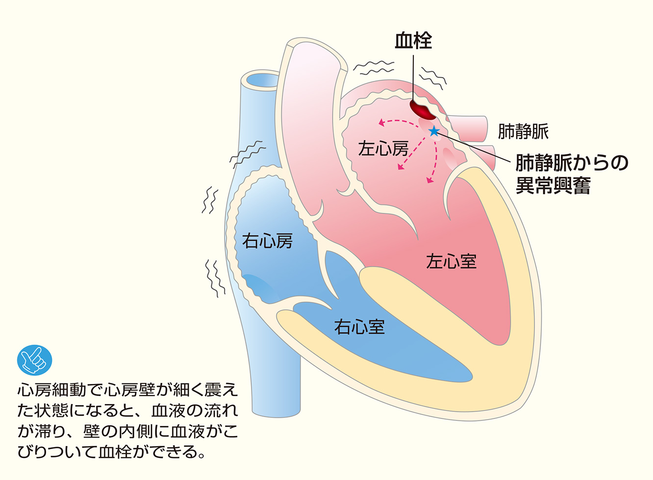 図10：心房細動と血栓