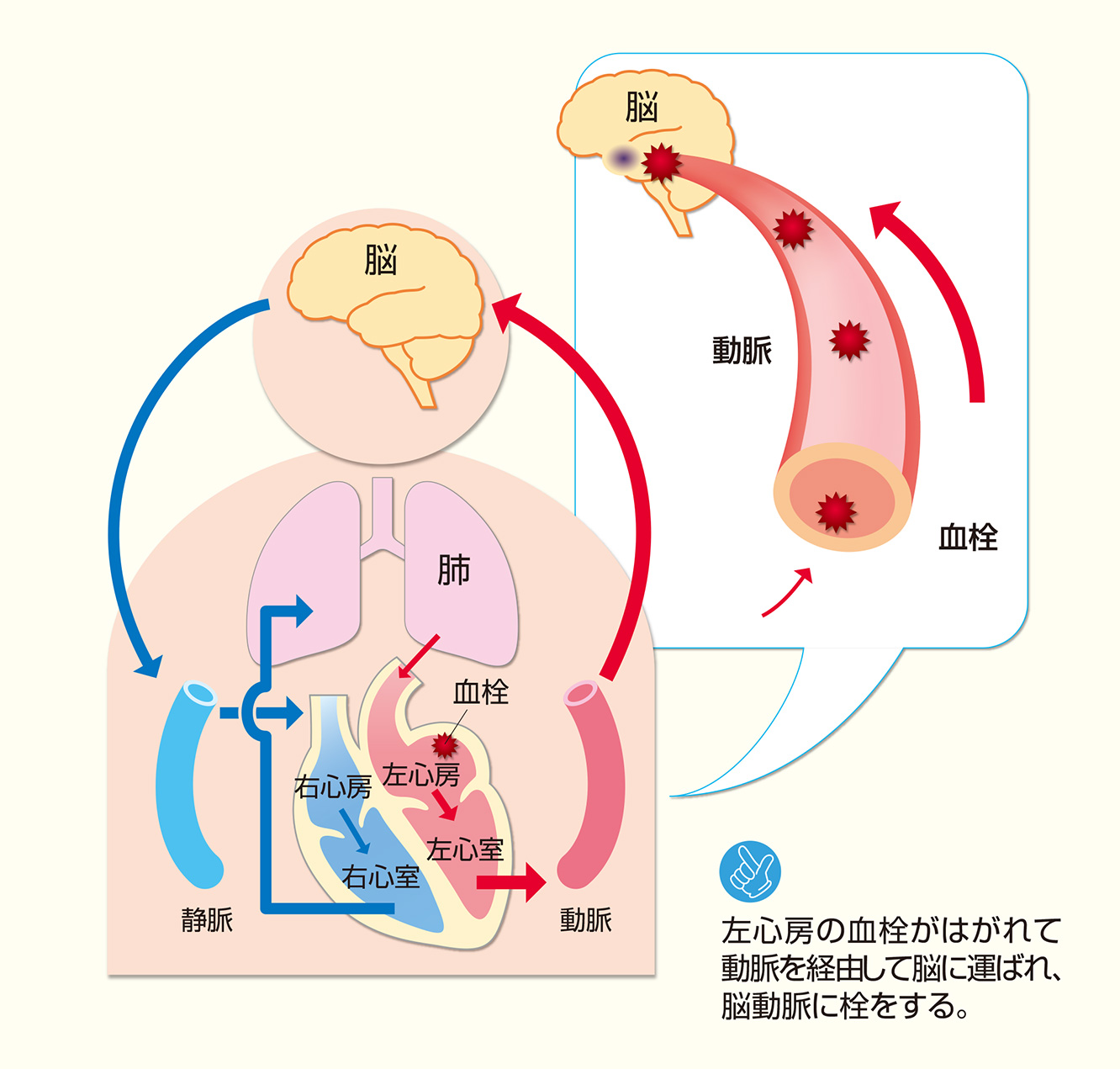 図11：心房細動と脳塞栓症