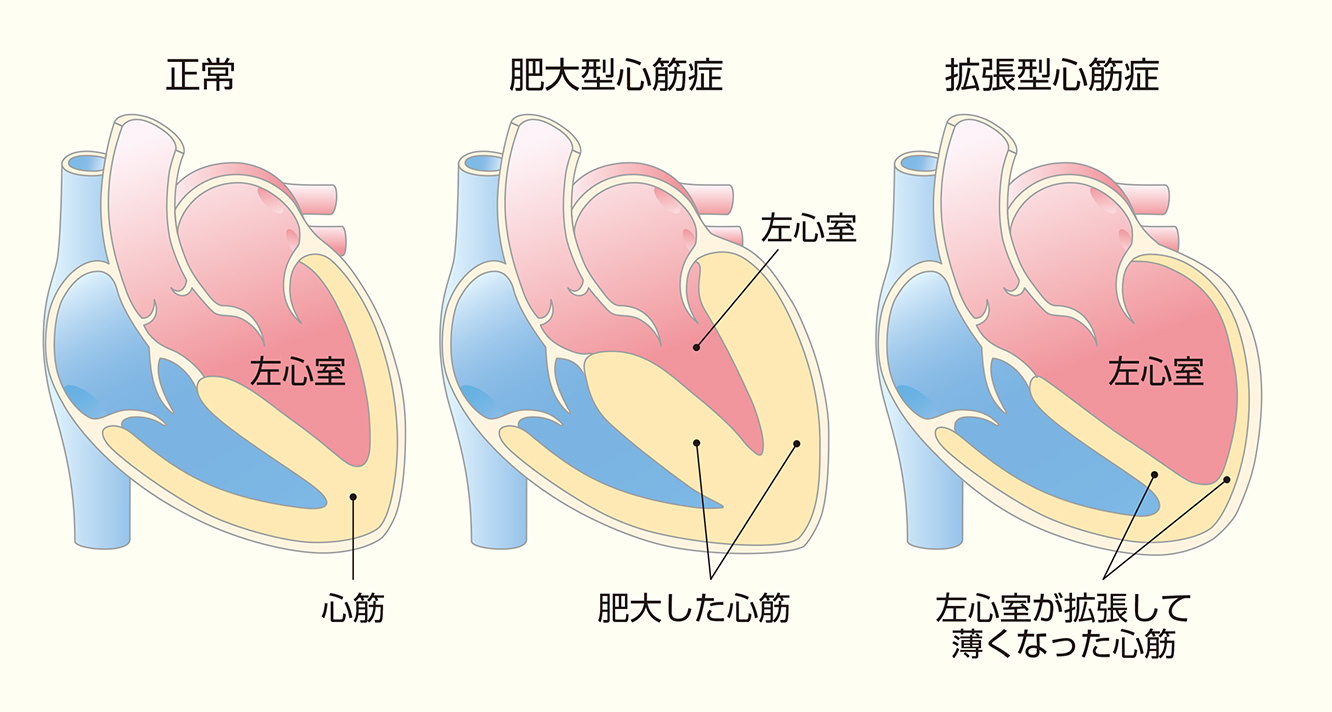 特発 性 拡張 型 心筋 症 症状