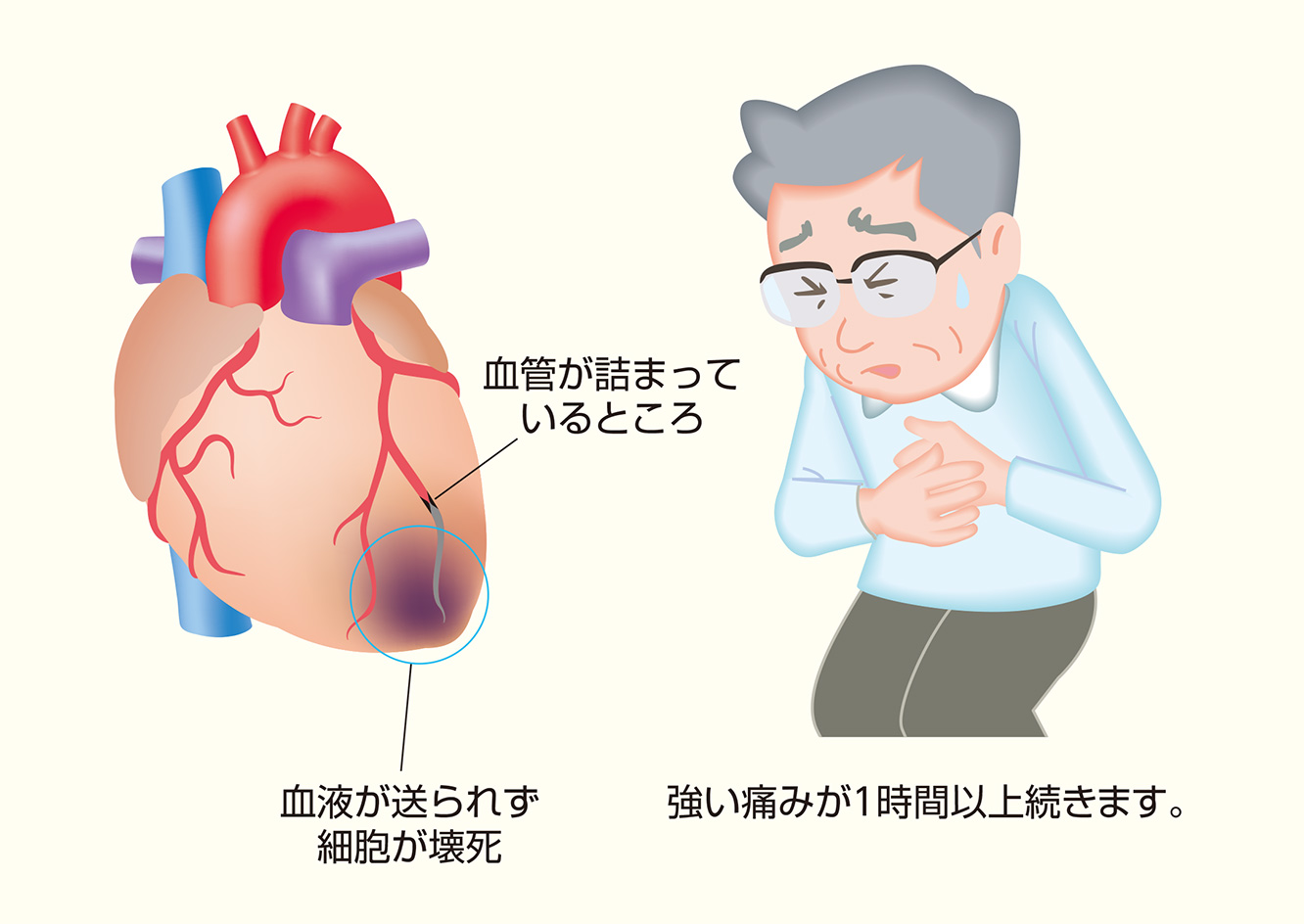 図6：心筋梗塞になると