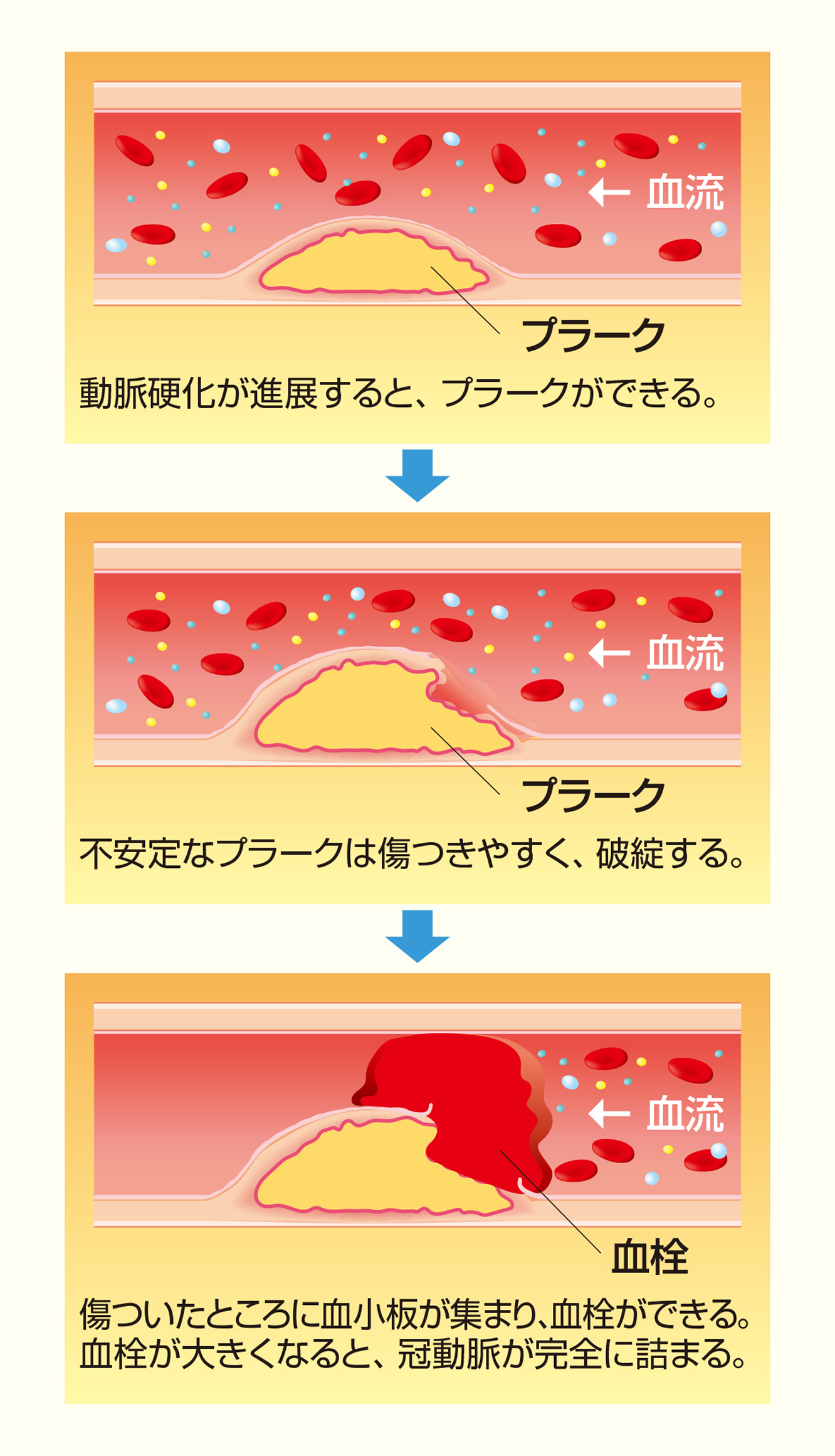 虚血性心疾患による心不全 高齢者の心不全 心臓病の知識 公益法人 日本心臓財団