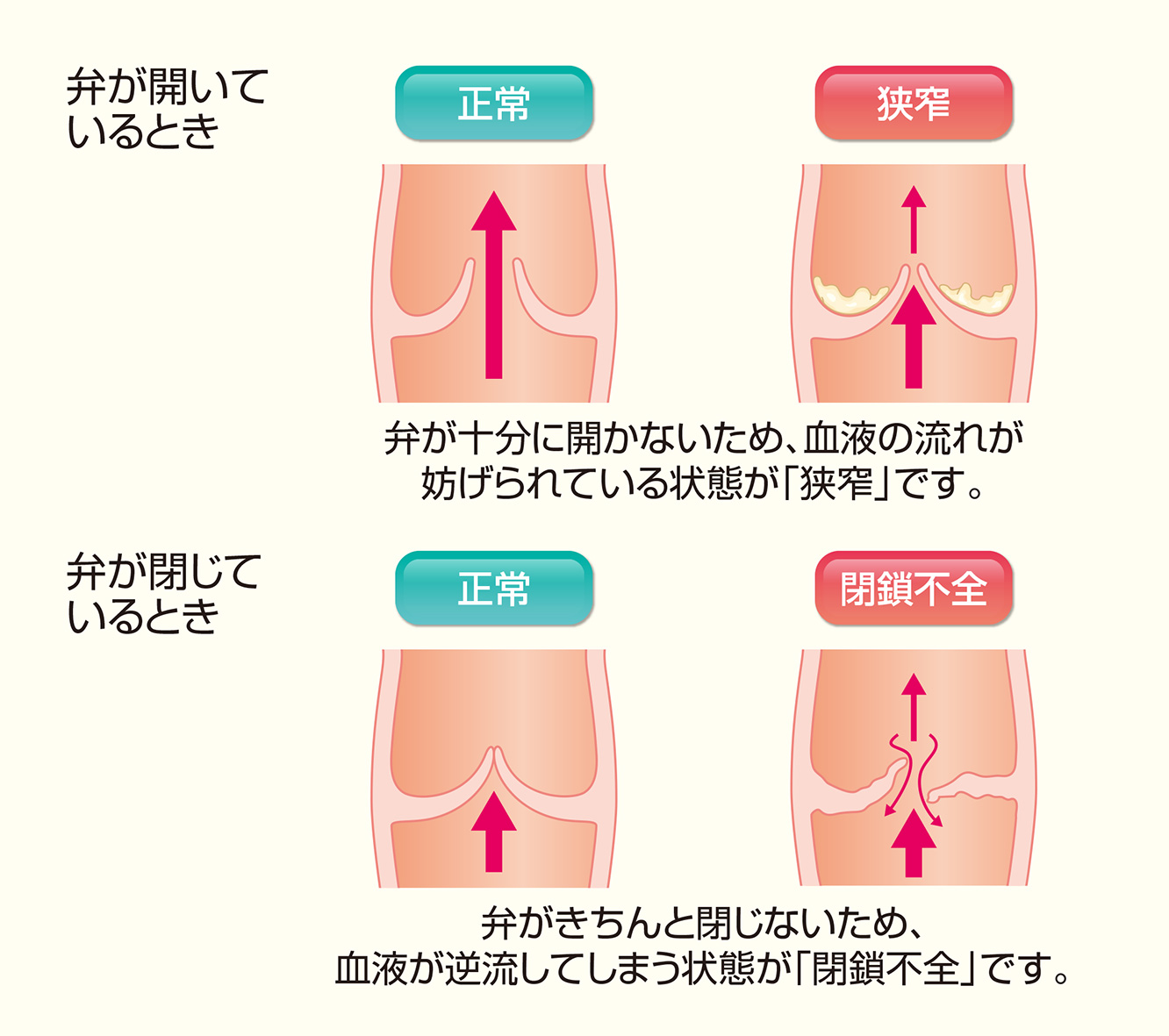 図9：弁膜症の状態