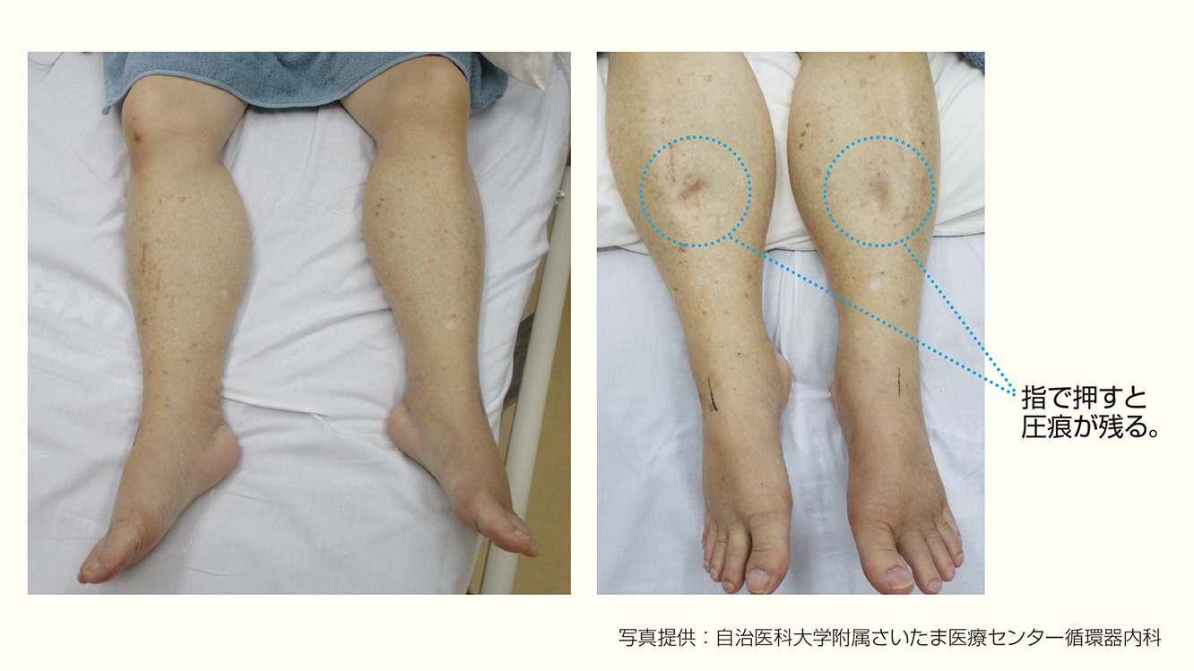 写真1：心不全で浮腫を起した足 / 写真2：圧痕性浮腫