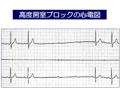 高度房室ブロック.png