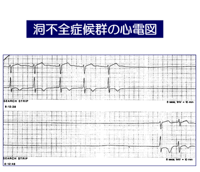 洞不全症候群.png