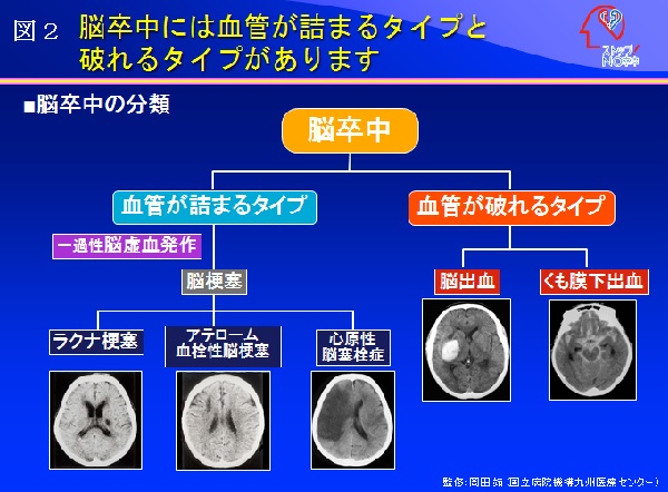 脳卒中、脳画像3点セット AI活用で脳卒中評価指標に合わせた色分け表示 富士フィルムが